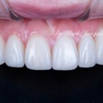 왜소치라미네이트, 여성스러운라미네이트, 앞니라미네이트, PegLateral, 최소삭제라미네이트, 박종욱원장, 압구정드림치과, 보존과전문의, 심미보철진단, 라미네이트잘하는곳, 치아디자인, 핸드메이드보철