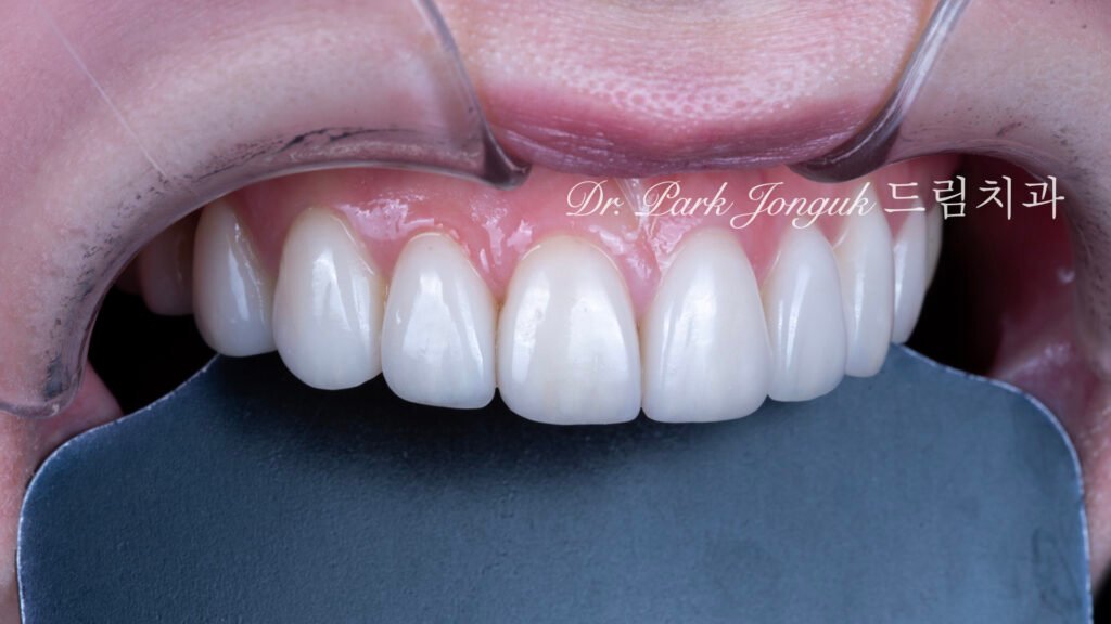 왜소치라미네이트, 여성스러운라미네이트, 앞니라미네이트, PegLateral, 최소삭제라미네이트, 박종욱원장, 압구정드림치과, 보존과전문의, 심미보철진단, 라미네이트잘하는곳, 치아디자인, 핸드메이드보철