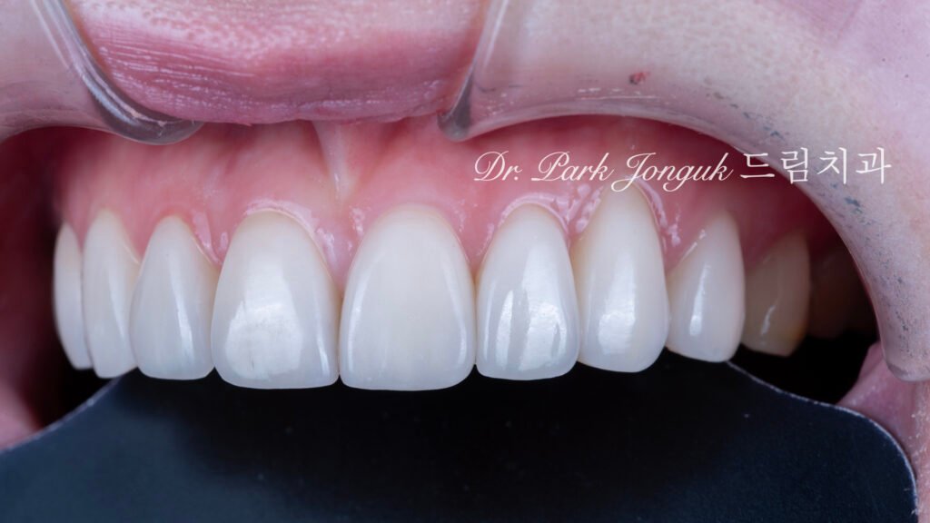 왜소치라미네이트, 여성스러운라미네이트, 앞니라미네이트, PegLateral, 최소삭제라미네이트, 박종욱원장, 압구정드림치과, 보존과전문의, 심미보철진단, 라미네이트잘하는곳, 치아디자인, 핸드메이드보철
