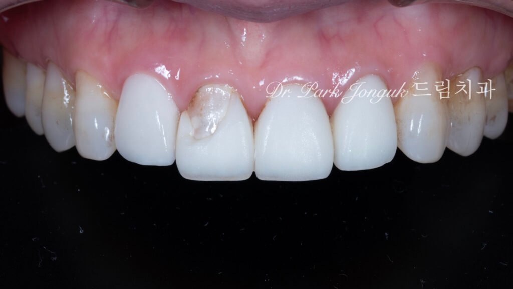 라미네이트 재시술, Laminate Revision, 과도한 치아 삭제, Excessive Tooth Preparation, 라미네이트 파절, Laminate Fracture, 상하악 통합 재건, Maxillo-Mandibular Reconstruction, 수작업 빌드업, Hand-Layered Build-up