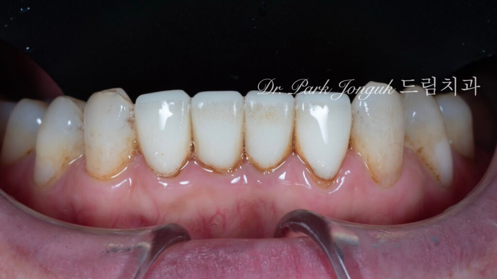 라미네이트 재시술, Laminate Revision, 과도한 치아 삭제, Excessive Tooth Preparation, 라미네이트 파절, Laminate Fracture, 상하악 통합 재건, Maxillo-Mandibular Reconstruction, 수작업 빌드업, Hand-Layered Build-up