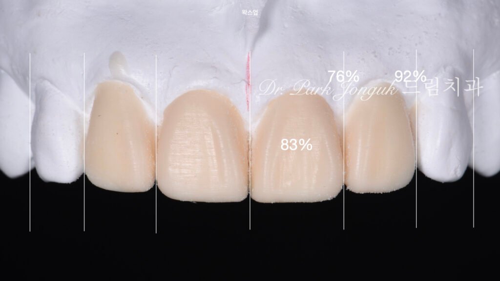 라미네이트 재시술, Laminate Revision, 과도한 치아 삭제, Excessive Tooth Preparation, 라미네이트 파절, Laminate Fracture, 상하악 통합 재건, Maxillo-Mandibular Reconstruction, 수작업 빌드업, Hand-Layered Build-up