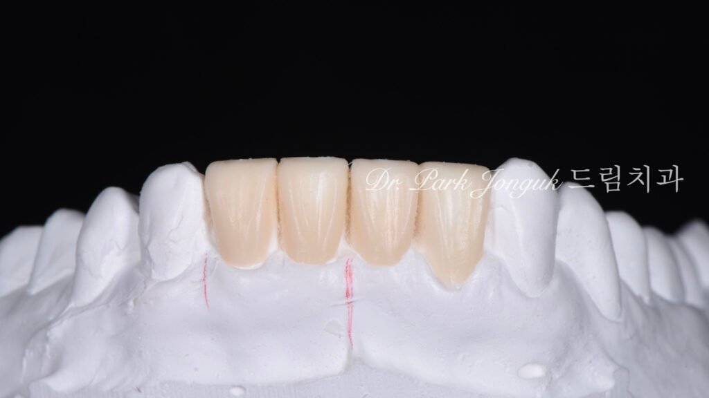라미네이트 재시술, Laminate Revision, 과도한 치아 삭제, Excessive Tooth Preparation, 라미네이트 파절, Laminate Fracture, 상하악 통합 재건, Maxillo-Mandibular Reconstruction, 수작업 빌드업, Hand-Layered Build-up