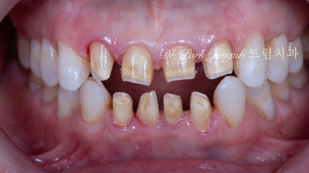 라미네이트 재시술, Laminate Revision, 과도한 치아 삭제, Excessive Tooth Preparation, 라미네이트 파절, Laminate Fracture, 상하악 통합 재건, Maxillo-Mandibular Reconstruction, 수작업 빌드업, Hand-Layered Build-up