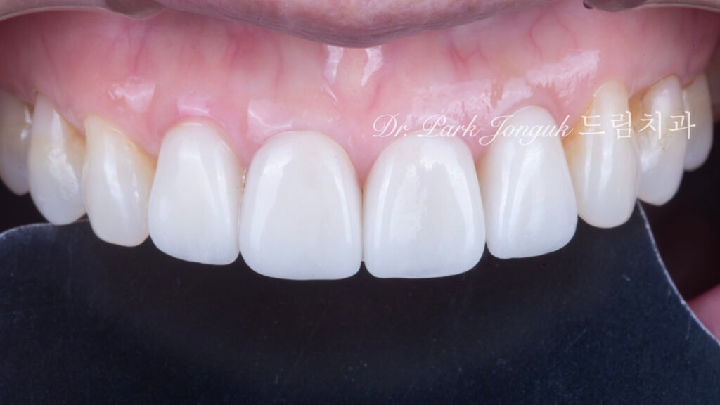 라미네이트 재시술, Laminate Revision, 과도한 치아 삭제, Excessive Tooth Preparation, 라미네이트 파절, Laminate Fracture, 상하악 통합 재건, Maxillo-Mandibular Reconstruction, 수작업 빌드업, Hand-Layered Build-up