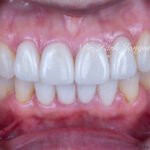 라미네이트 재시술, Laminate Revision, 과도한 치아 삭제, Excessive Tooth Preparation, 라미네이트 파절, Laminate Fracture, 상하악 통합 재건, Maxillo-Mandibular Reconstruction, 수작업 빌드업, Hand-Layered Build-up