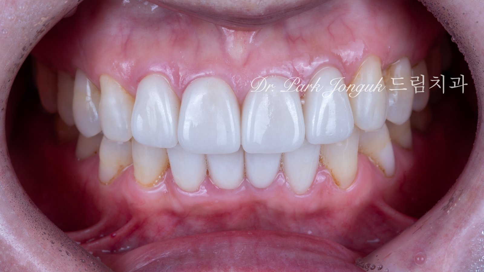 라미네이트 재시술, Laminate Revision, 과도한 치아 삭제, Excessive Tooth Preparation, 라미네이트 파절, Laminate Fracture, 상하악 통합 재건, Maxillo-Mandibular Reconstruction, 수작업 빌드업, Hand-Layered Build-up