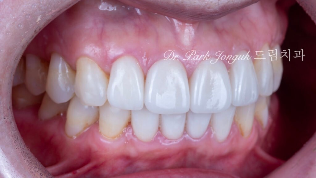 라미네이트 재시술, Laminate Revision, 과도한 치아 삭제, Excessive Tooth Preparation, 라미네이트 파절, Laminate Fracture, 상하악 통합 재건, Maxillo-Mandibular Reconstruction, 수작업 빌드업, Hand-Layered Build-up