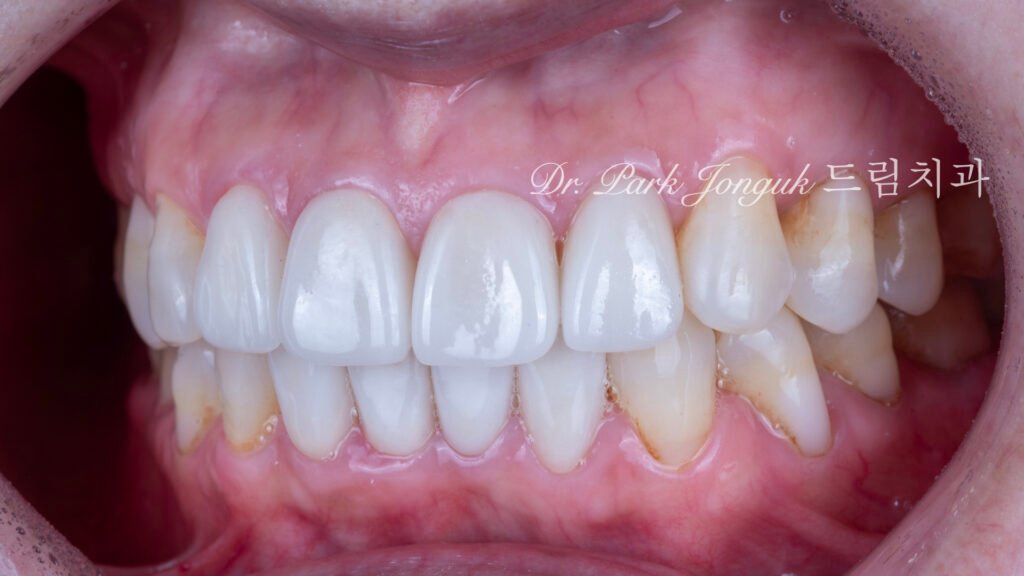 라미네이트 재시술, Laminate Revision, 과도한 치아 삭제, Excessive Tooth Preparation, 라미네이트 파절, Laminate Fracture, 상하악 통합 재건, Maxillo-Mandibular Reconstruction, 수작업 빌드업, Hand-Layered Build-up