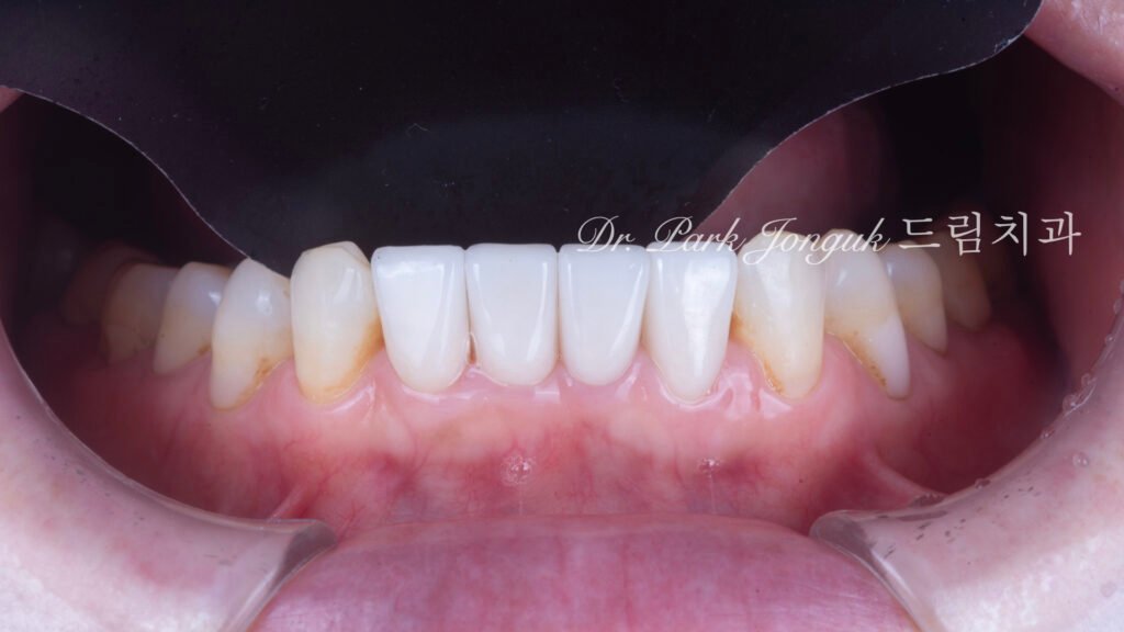 라미네이트 재시술, Laminate Revision, 과도한 치아 삭제, Excessive Tooth Preparation, 라미네이트 파절, Laminate Fracture, 상하악 통합 재건, Maxillo-Mandibular Reconstruction, 수작업 빌드업, Hand-Layered Build-up