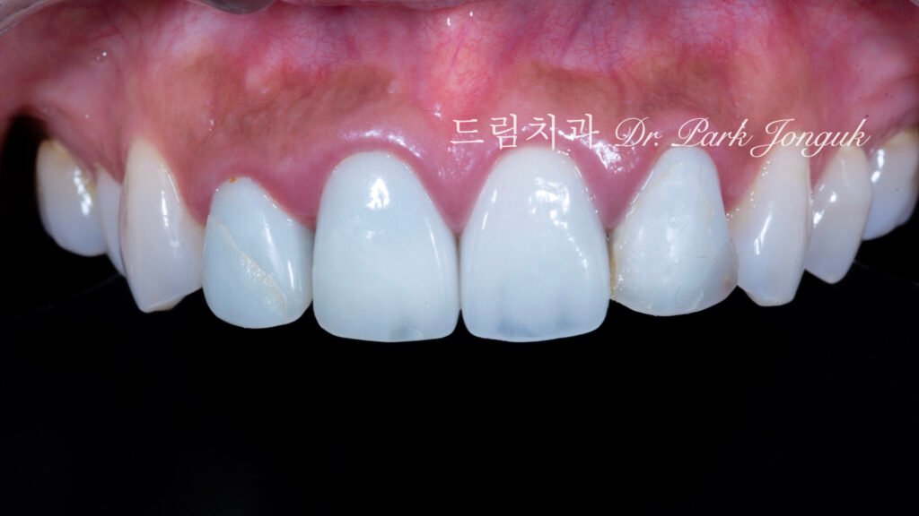 라미네이트 재시술, Laminate Revision, 올세라믹 크라운 재시술, All-Ceramic Crown Revision, 라미네이트 깨짐, Laminate Fracture, 신경 치료 후 변색, Post-Endodontic Discoloration