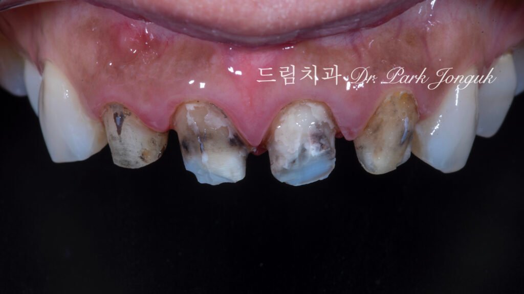라미네이트 재시술, Laminate Revision, 올세라믹 크라운 재시술, All-Ceramic Crown Revision, 라미네이트 깨짐, Laminate Fracture, 신경 치료 후 변색, Post-Endodontic Discoloration