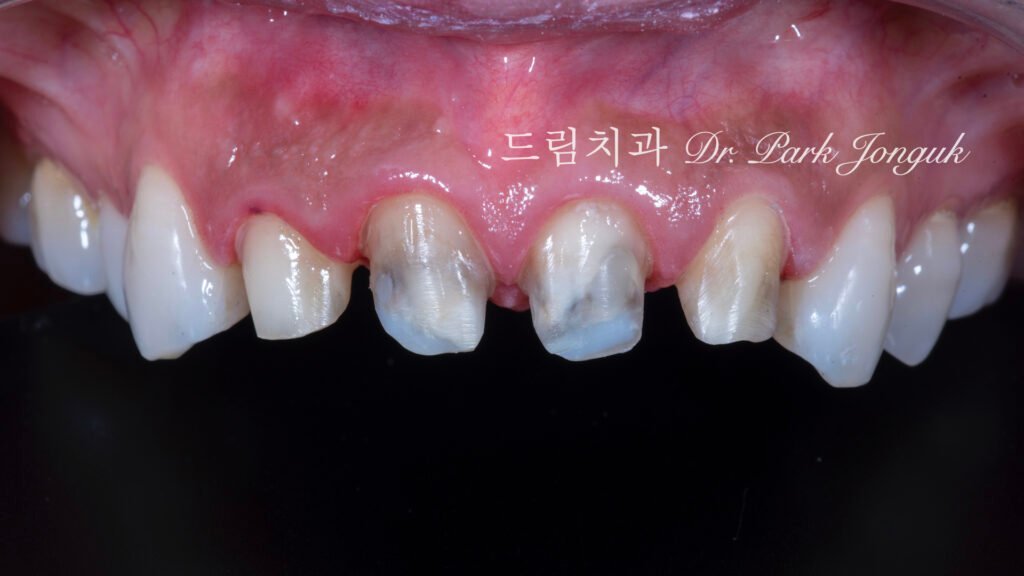 라미네이트 재시술, Laminate Revision, 올세라믹 크라운 재시술, All-Ceramic Crown Revision, 라미네이트 깨짐, Laminate Fracture, 신경 치료 후 변색, Post-Endodontic Discoloration