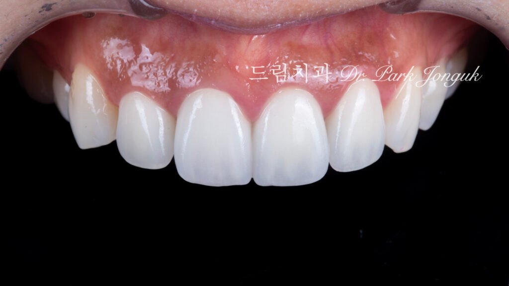 라미네이트 재시술, Laminate Revision, 올세라믹 크라운 재시술, All-Ceramic Crown Revision, 라미네이트 깨짐, Laminate Fracture, 신경 치료 후 변색, Post-Endodontic Discoloration