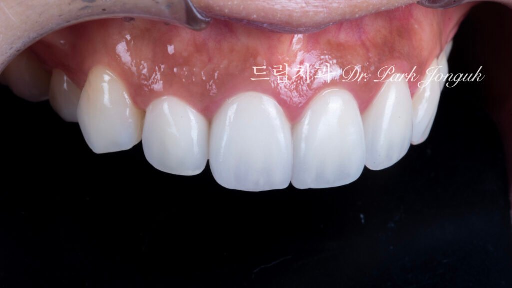 라미네이트 재시술, Laminate Revision, 올세라믹 크라운 재시술, All-Ceramic Crown Revision, 라미네이트 깨짐, Laminate Fracture, 신경 치료 후 변색, Post-Endodontic Discoloration