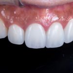 라미네이트 재시술, Laminate Revision, 올세라믹 크라운 재시술, All-Ceramic Crown Revision, 라미네이트 깨짐, Laminate Fracture, 신경 치료 후 변색, Post-Endodontic Discoloration