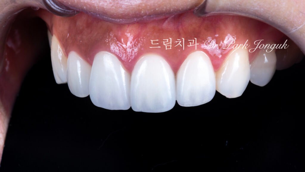 라미네이트 재시술, Laminate Revision, 올세라믹 크라운 재시술, All-Ceramic Crown Revision, 라미네이트 깨짐, Laminate Fracture, 신경 치료 후 변색, Post-Endodontic Discoloration