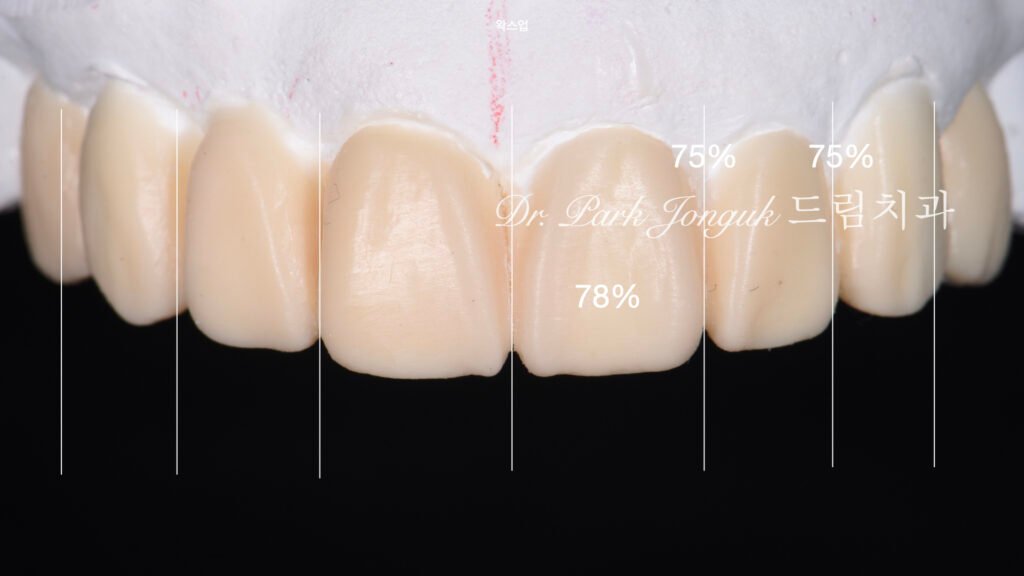 무삭제라미네이트, 올세라믹크라운, 앞니브릿지재시술, 치아삭제량, 심미치과진단, 박종욱원장, 압구정드림치과, 라미네이트교과서, 보존과전문의, 핸드메이드치아, 심미보철복원, 디지털왁스업, 재치료솔루션