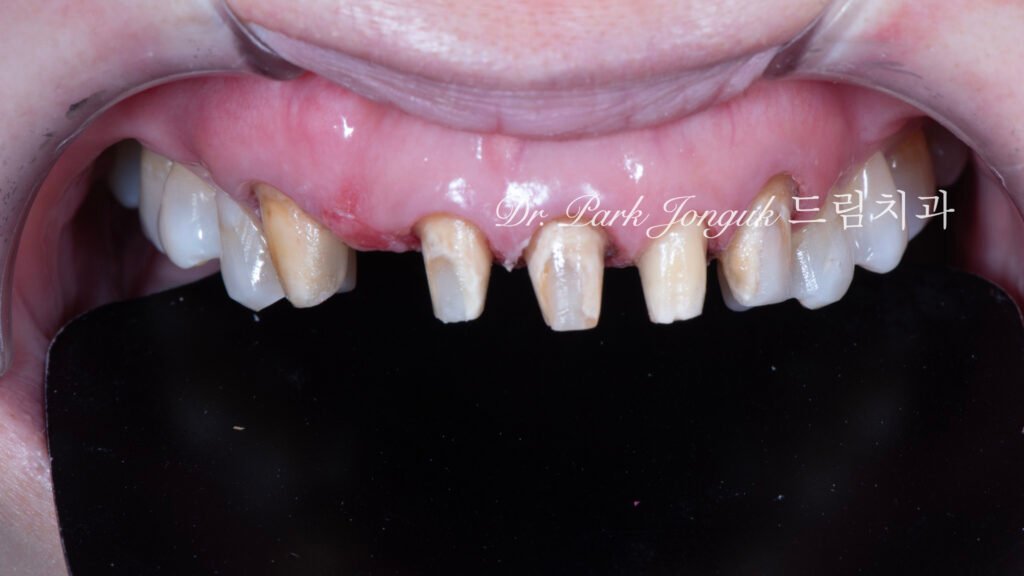 무삭제라미네이트, 올세라믹크라운, 앞니브릿지재시술, 치아삭제량, 심미치과진단, 박종욱원장, 압구정드림치과, 라미네이트교과서, 보존과전문의, 핸드메이드치아, 심미보철복원, 디지털왁스업, 재치료솔루션