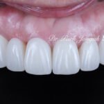 무삭제라미네이트, 올세라믹크라운, 앞니브릿지재시술, 치아삭제량, 심미치과진단, 박종욱원장, 압구정드림치과, 라미네이트교과서, 보존과전문의, 핸드메이드치아, 심미보철복원, 디지털왁스업, 재치료솔루션