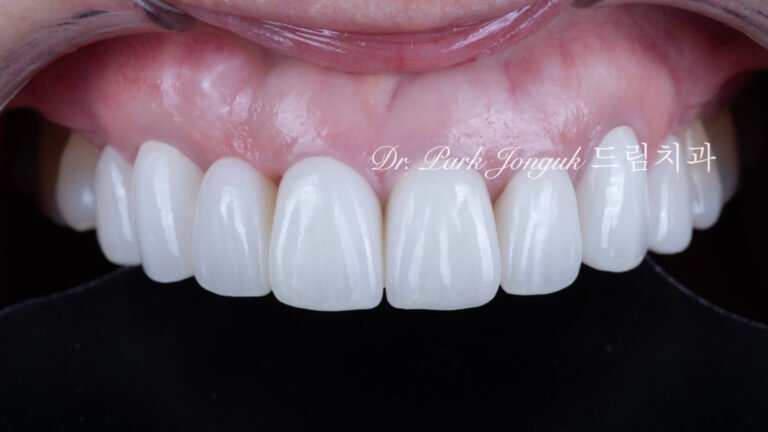 무삭제라미네이트, 올세라믹크라운, 앞니브릿지재시술, 치아삭제량, 심미치과진단, 박종욱원장, 압구정드림치과, 라미네이트교과서, 보존과전문의, 핸드메이드치아, 심미보철복원, 디지털왁스업, 재치료솔루션