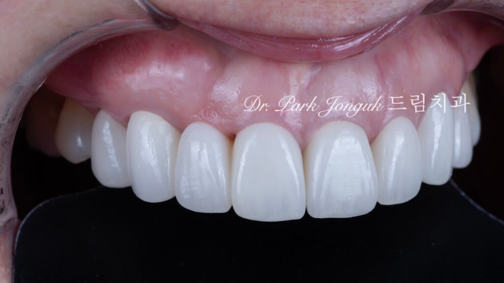 무삭제라미네이트, 올세라믹크라운, 앞니브릿지재시술, 치아삭제량, 심미치과진단, 박종욱원장, 압구정드림치과, 라미네이트교과서, 보존과전문의, 핸드메이드치아, 심미보철복원, 디지털왁스업, 재치료솔루션