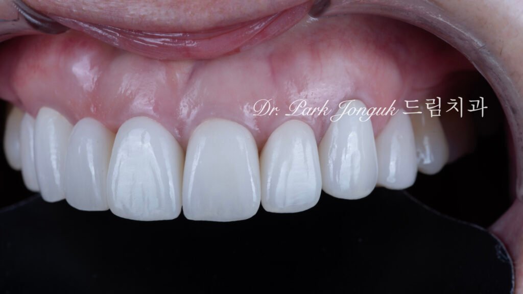 무삭제라미네이트, 올세라믹크라운, 앞니브릿지재시술, 치아삭제량, 심미치과진단, 박종욱원장, 압구정드림치과, 라미네이트교과서, 보존과전문의, 핸드메이드치아, 심미보철복원, 디지털왁스업, 재치료솔루션