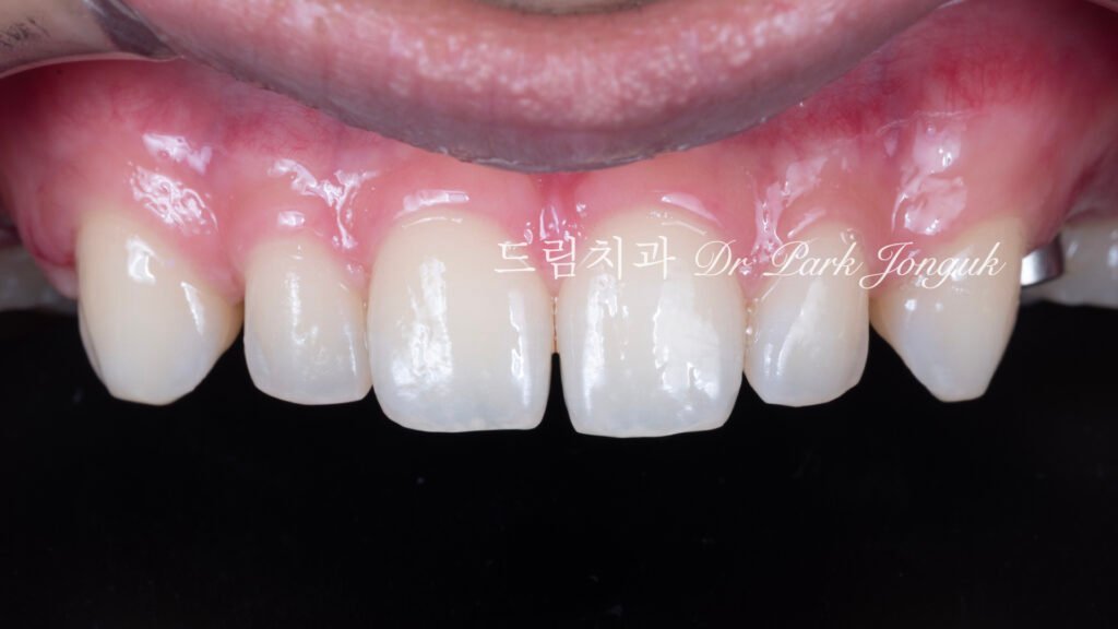 무삭제 라미네이트, No-Prep Laminate, 정밀 진단, Diagnostic Wax-up, 왁스업 진단, Diagnostic Wax-up, 비율 최적화, Proportion Optimization, 시각적 축소, Visual Reduction, 과대 치아, Oversized Teeth