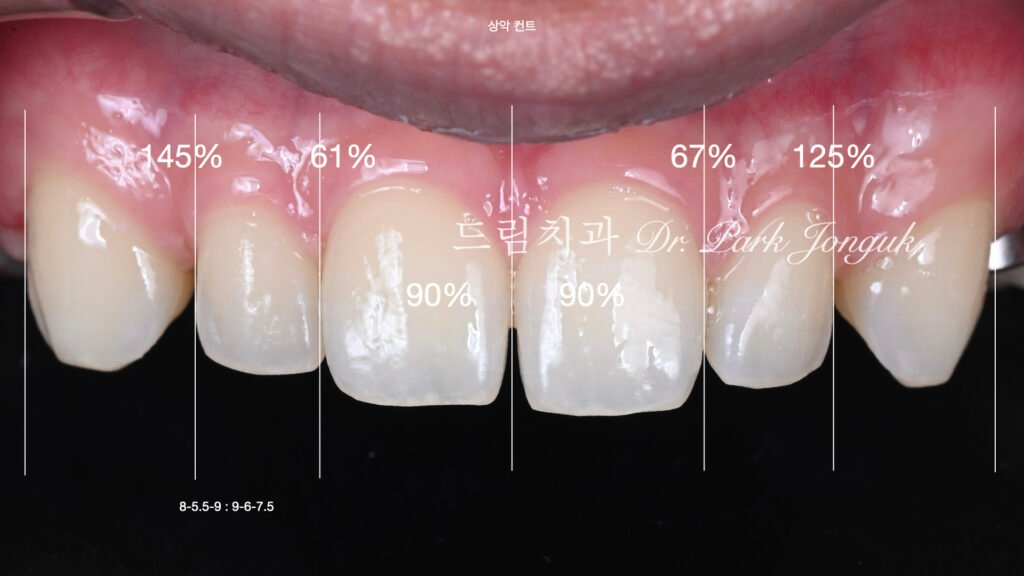 무삭제 라미네이트, No-Prep Laminate, 정밀 진단, Diagnostic Wax-up, 왁스업 진단, Diagnostic Wax-up, 비율 최적화, Proportion Optimization, 시각적 축소, Visual Reduction, 과대 치아, Oversized Teeth