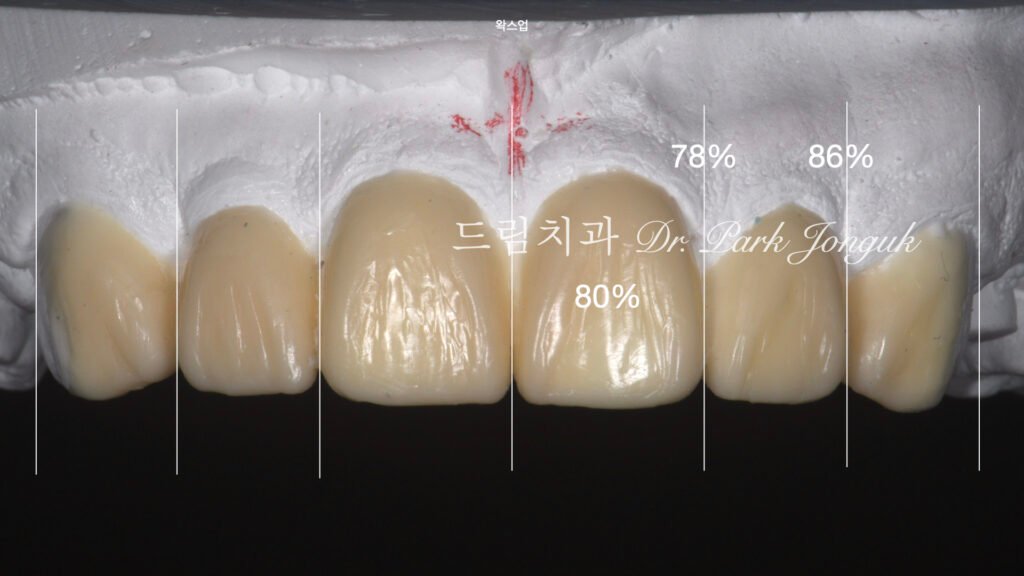 무삭제 라미네이트, No-Prep Laminate, 정밀 진단, Diagnostic Wax-up, 왁스업 진단, Diagnostic Wax-up, 비율 최적화, Proportion Optimization, 시각적 축소, Visual Reduction, 과대 치아, Oversized Teeth