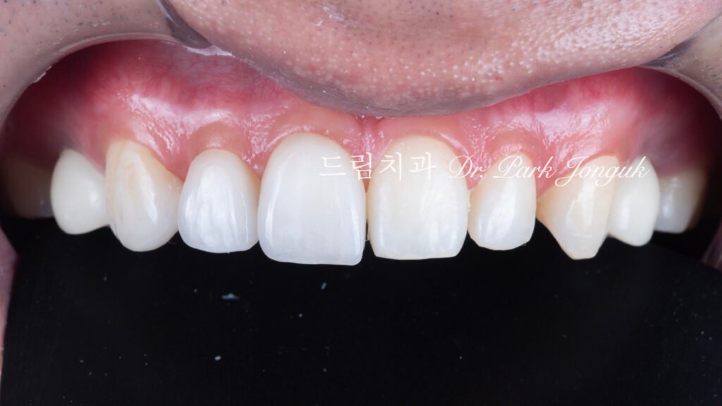 무삭제 라미네이트, No-Prep Laminate, 정밀 진단, Diagnostic Wax-up, 왁스업 진단, Diagnostic Wax-up, 비율 최적화, Proportion Optimization, 시각적 축소, Visual Reduction, 과대 치아, Oversized Teeth