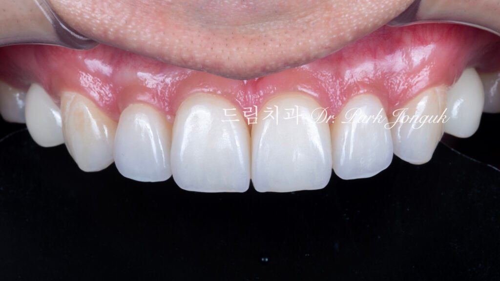 무삭제 라미네이트, No-Prep Laminate, 정밀 진단, Diagnostic Wax-up, 왁스업 진단, Diagnostic Wax-up, 비율 최적화, Proportion Optimization, 시각적 축소, Visual Reduction, 과대 치아, Oversized Teeth