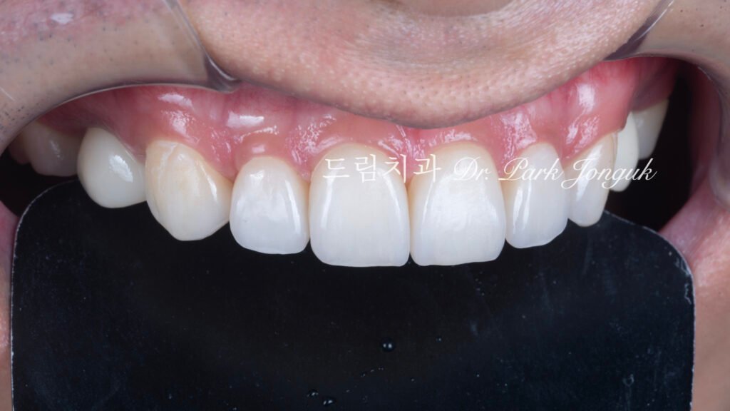 무삭제 라미네이트, No-Prep Laminate, 정밀 진단, Diagnostic Wax-up, 왁스업 진단, Diagnostic Wax-up, 비율 최적화, Proportion Optimization, 시각적 축소, Visual Reduction, 과대 치아, Oversized Teeth