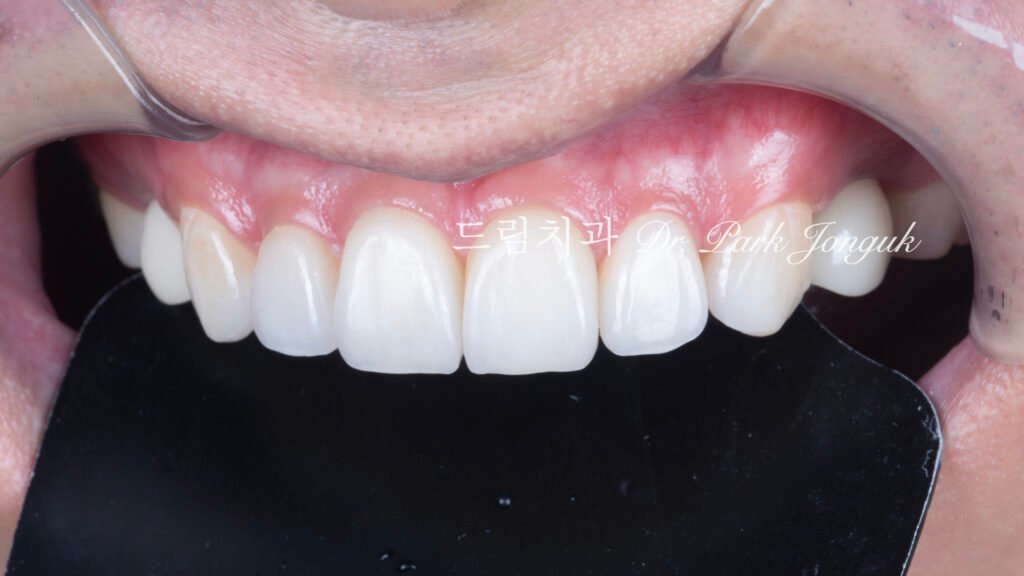 무삭제 라미네이트, No-Prep Laminate, 정밀 진단, Diagnostic Wax-up, 왁스업 진단, Diagnostic Wax-up, 비율 최적화, Proportion Optimization, 시각적 축소, Visual Reduction, 과대 치아, Oversized Teeth