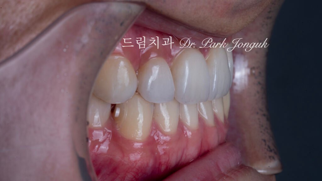 무삭제 라미네이트, No-Prep Laminate, 정밀 진단, Diagnostic Wax-up, 왁스업 진단, Diagnostic Wax-up, 비율 최적화, Proportion Optimization, 시각적 축소, Visual Reduction, 과대 치아, Oversized Teeth