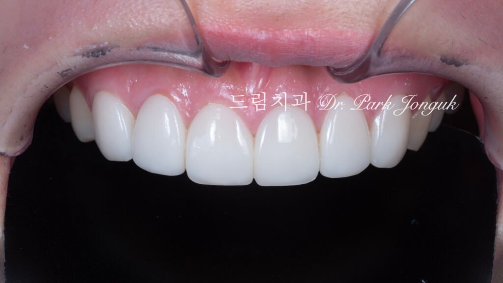 라미네이트 재시술, Laminate Revision, 조기 재시술, Early Revision, 부분 재시술, Selective Revision, 레이저 제거, Laser Removal, 비율 최적화, Proportion Optimization