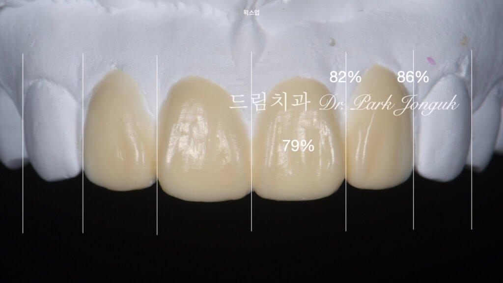 라미네이트 재시술, Laminate Revision, 조기 재시술, Early Revision, 부분 재시술, Selective Revision, 레이저 제거, Laser Removal, 비율 최적화, Proportion Optimization