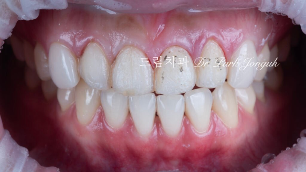 라미네이트 재시술, Laminate Revision, 조기 재시술, Early Revision, 부분 재시술, Selective Revision, 레이저 제거, Laser Removal, 비율 최적화, Proportion Optimization