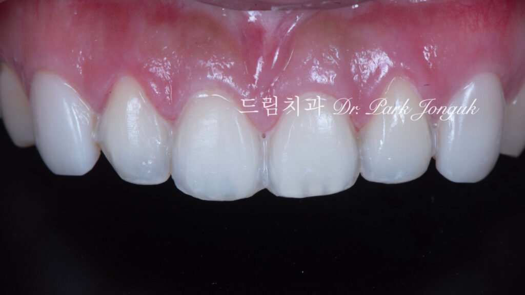 라미네이트 재시술, Laminate Revision, 조기 재시술, Early Revision, 부분 재시술, Selective Revision, 레이저 제거, Laser Removal, 비율 최적화, Proportion Optimization