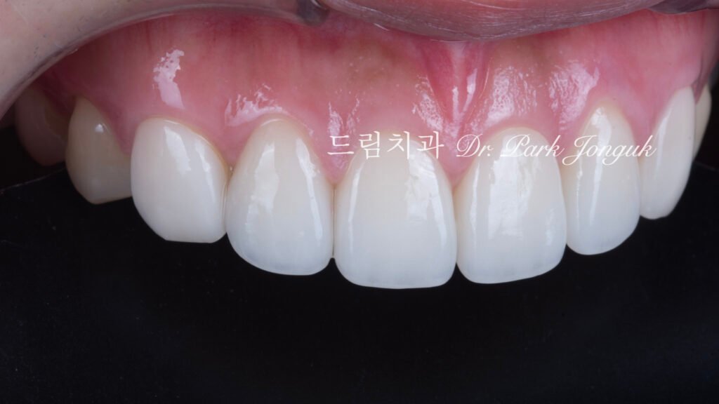 라미네이트 재시술, Laminate Revision, 조기 재시술, Early Revision, 부분 재시술, Selective Revision, 레이저 제거, Laser Removal, 비율 최적화, Proportion Optimization