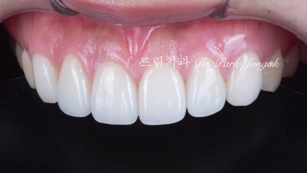 라미네이트 재시술, Laminate Revision, 조기 재시술, Early Revision, 부분 재시술, Selective Revision, 레이저 제거, Laser Removal, 비율 최적화, Proportion Optimization