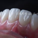 라미네이트 재시술, Laminate Revision, 조기 재시술, Early Revision, 부분 재시술, Selective Revision, 레이저 제거, Laser Removal, 비율 최적화, Proportion Optimization