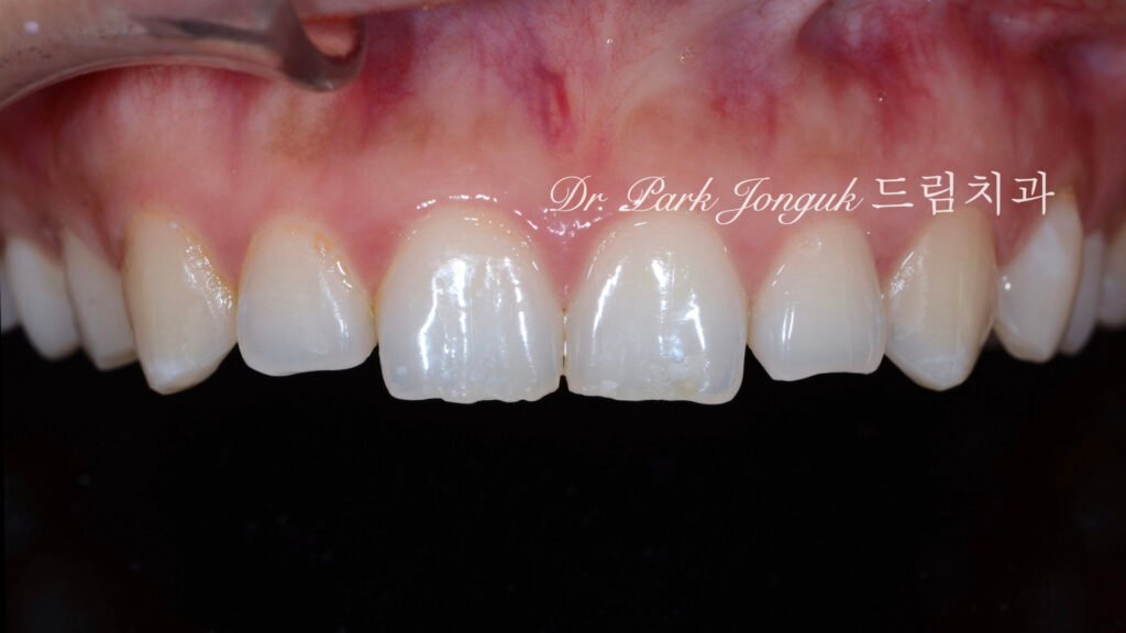 무삭제 라미네이트, No-Prep Laminate, 교정 후 라미네이트, Post-Orthodontic Laminate, 교정 후 옥니, Post-Orthodontic Retroclined Teeth, 옥니 라미네이트, Laminate for Retroclined Teeth, 다층 빌드업, Multi-Layered Build-up