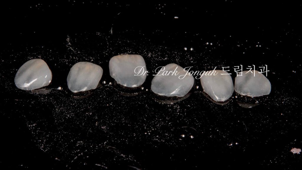 무삭제 라미네이트, No-Prep Laminate, 교정 후 라미네이트, Post-Orthodontic Laminate, 교정 후 옥니, Post-Orthodontic Retroclined Teeth, 옥니 라미네이트, Laminate for Retroclined Teeth, 다층 빌드업, Multi-Layered Build-up