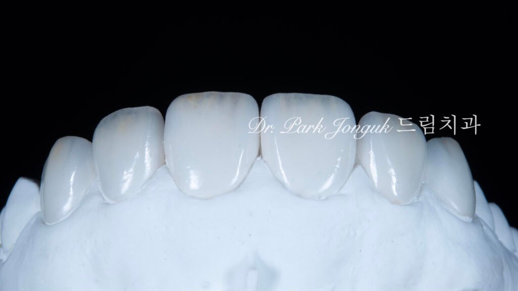 무삭제 라미네이트, No-Prep Laminate, 교정 후 라미네이트, Post-Orthodontic Laminate, 교정 후 옥니, Post-Orthodontic Retroclined Teeth, 옥니 라미네이트, Laminate for Retroclined Teeth, 다층 빌드업, Multi-Layered Build-up