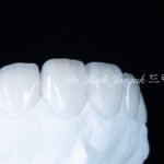 무삭제 라미네이트, No-Prep Laminate, 교정 후 라미네이트, Post-Orthodontic Laminate, 교정 후 옥니, Post-Orthodontic Retroclined Teeth, 옥니 라미네이트, Laminate for Retroclined Teeth, 다층 빌드업, Multi-Layered Build-up