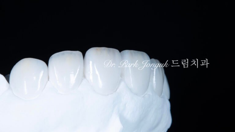 무삭제 라미네이트, No-Prep Laminate, 교정 후 라미네이트, Post-Orthodontic Laminate, 교정 후 옥니, Post-Orthodontic Retroclined Teeth, 옥니 라미네이트, Laminate for Retroclined Teeth, 다층 빌드업, Multi-Layered Build-up