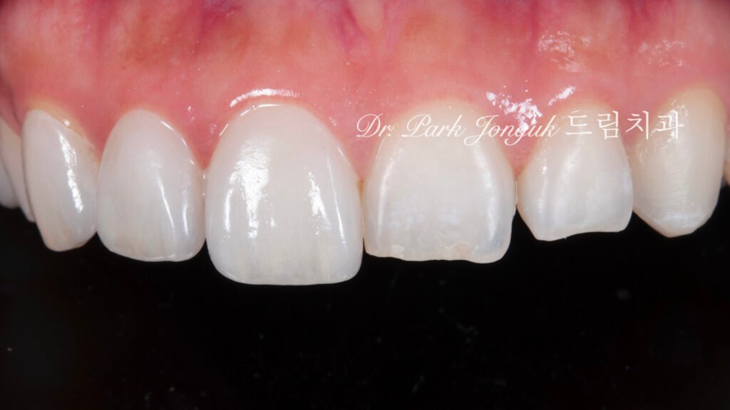 무삭제 라미네이트, No-Prep Laminate, 교정 후 라미네이트, Post-Orthodontic Laminate, 교정 후 옥니, Post-Orthodontic Retroclined Teeth, 옥니 라미네이트, Laminate for Retroclined Teeth, 다층 빌드업, Multi-Layered Build-up