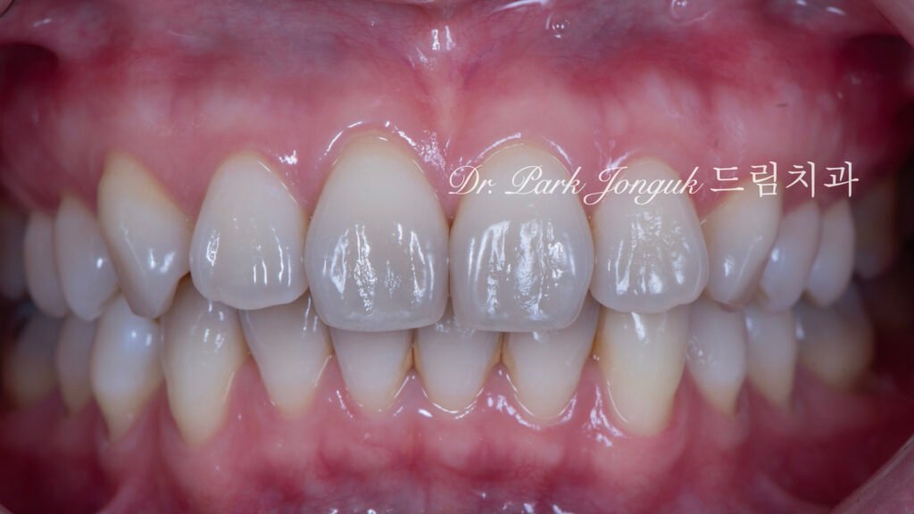 변색치아 라미네이트, Laminate for Discolored Teeth, 테트라사이클린 변색, Tetracycline Staining, 어두운 치아 라미네이트, Laminate for Dark Teeth, 항생제 변색, Antibiotic Staining, 내인성 변색, Intrinsic Discoloration, 변색 차폐, Discoloration Masking