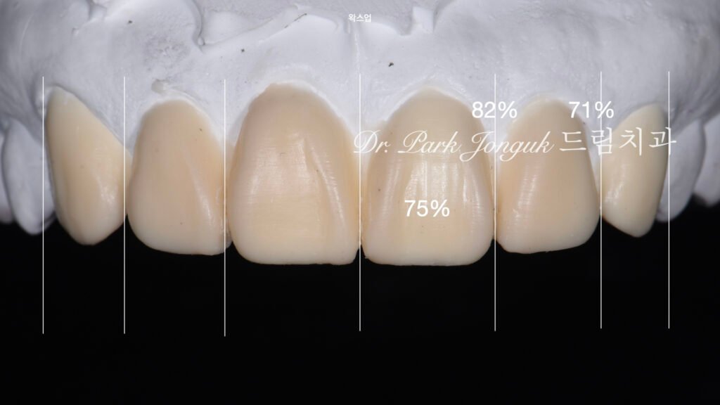 변색치아 라미네이트, Laminate for Discolored Teeth, 테트라사이클린 변색, Tetracycline Staining, 어두운 치아 라미네이트, Laminate for Dark Teeth, 항생제 변색, Antibiotic Staining, 내인성 변색, Intrinsic Discoloration, 변색 차폐, Discoloration Masking